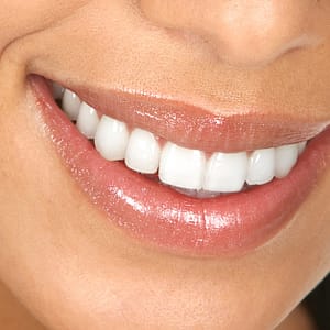 Blanqueamiento con limpieza bucal avanzada con estudio dental completo Madrid Cyja.com Special Offers, Deals & Discounts in Spain